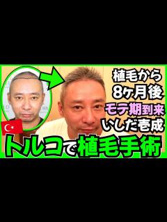 [x]【生え際、髪の毛】いしだ壱成の植毛8ヶ月後 人生がV字回復してモテ期到来!?【トルコ植毛｜薄毛の窓口】 - YouTube