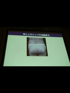 [x]同一人物のヒップの加齢変化 - YouTube